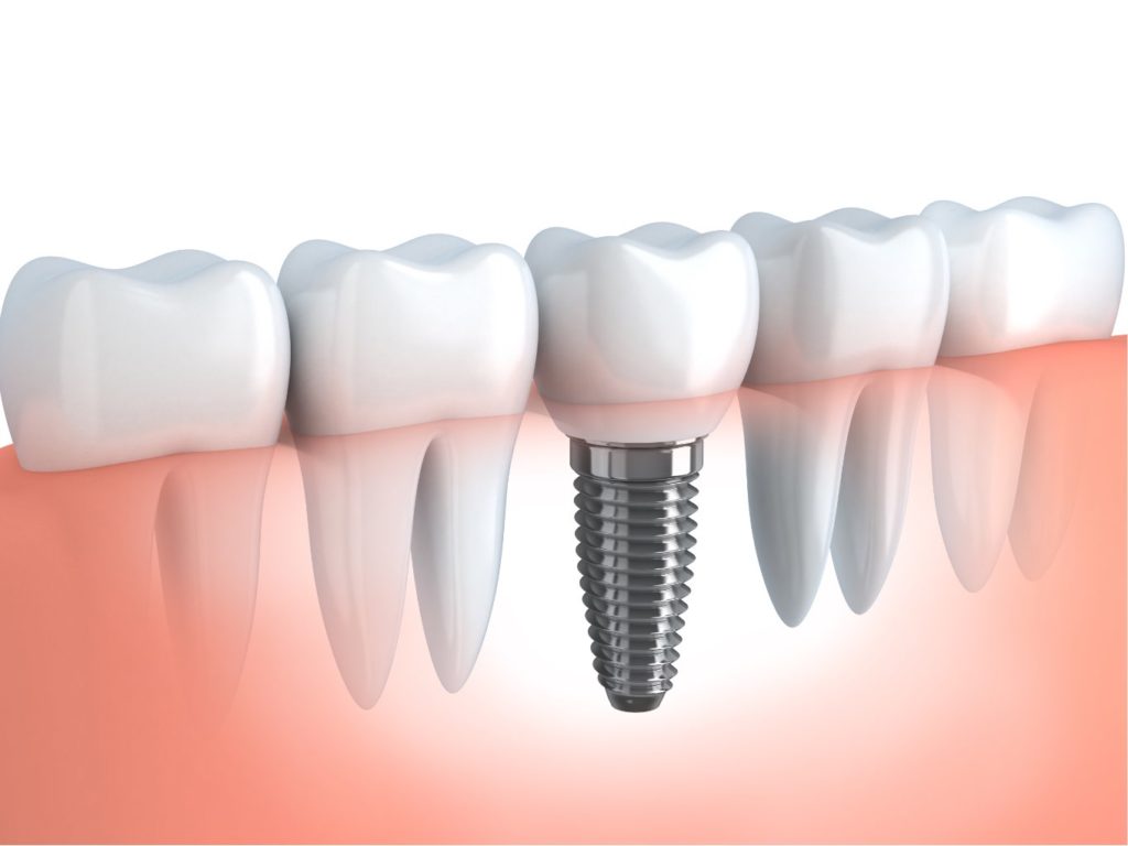 implantologia a carico immediato Gaeta | Studio dentistico Spinosa | Dentista a Gaeta