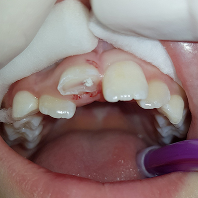 Casi clinici 2 | Studio dentistico Spinosa | Dentista a Gaeta
